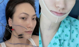 Nữ diễn viên Phương Anh Đào vừa phẫu thuật u tuyến giáp