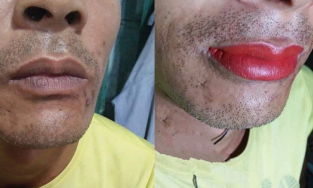 Ông bố nghe lời hàng xóm đi khử môi thâm và kết quả