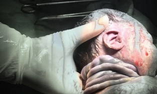 Hy hữu: Bé trai ở Hà Nội chào đời an toàn với 7 vòng dây rốn quấn chặt cổ