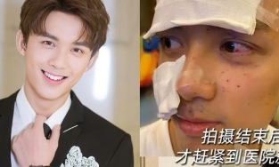 'Em trai quốc dân' Ngô Lỗi bị thương khắp mặt vì vụ nổ trên phim trường