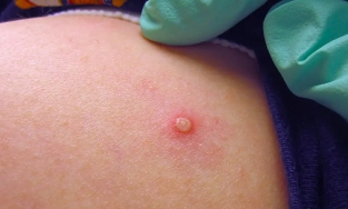 WHO tuyên bố đậu mùa khỉ là tình trạng khẩn cấp y tế toàn cầu