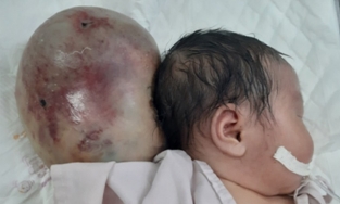 Loại bỏ khối u khổng lồ như cái đầu thứ 2 cho bé sơ sinh ở Đồng Tháp