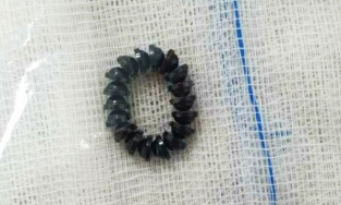 TP.HCM: Bé trai 3 tuổi phải nối ruột do nuốt 18 viên nam châm