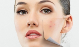 Xướng tên 4 loại kem trị thâm mụn hữu hiệu cho mọi loại da