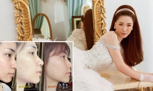 Can đảm như Hoà Minzy: Khoe làn da trị mụn thịt chi chít vết sẹo