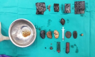 Hà Nội: Tìm thấy nhiều dị vật trong dạ dày bệnh nhân