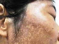 Da mặt thành “bánh đa vừng đen” vì bôi kem trộn làm trắng không rõ nguồn ốc