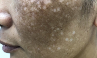 Một phụ nữ mất nửa tỷ chữa nám má, nhận lại khuôn mặt đầy sẹo và nám