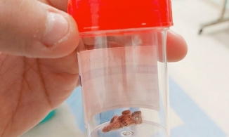 Miếng bông gòn kẹt trong âm đạo bé 6 tuổi