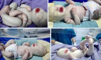 Bé bị da vảy cá bẩm sinh ở Hà Giang có tình trạng rất nặng