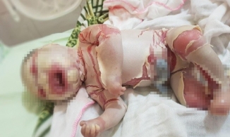 Bé sơ sinh có lớp da vảy cá ở Hà Giang được xuất viện