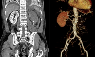 Người đàn ông mắc căn bệnh phình động mạch hiếm gặp 