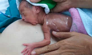 Nuôi sống bé sinh non nhỏ như con chuột bằng cách 'ấp' trên da mẹ 24/24h