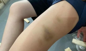 Huế: Phụ huynh tố cô giáo đánh học sinh lớp 1 bầm tím người