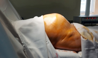 Người phụ nữ mang khối u to như thai nhi 7 tháng tuổi