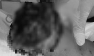 Nổ bình ga mini: người đàn ông chấn thương sọ não, mất đi bàn tay phải