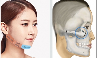 Phẫu thuật hạ gò má và những điều cần biết