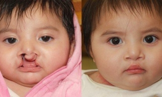 Phẫu thuật hở hàm ếch: 'Phẫu thuật thẩm mỹ' mang lại nụ cười cho trẻ