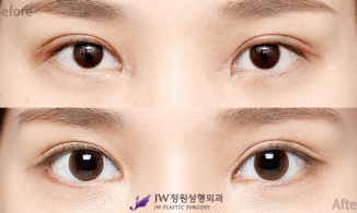 Những điều cần biết về phẫu thuật mở góc mắt trong