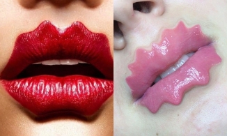 Trào lưu tiêm filler tạo dáng môi 'quái lạ': Đẹp hay kì dị?