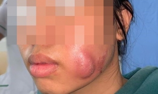 Tạo má lúm đồng tiền làm duyên ở cơ sở không uy tín, thiếu nữ 16 tuổi bị sưng vù mặt