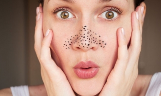 Bạn có nên nặn mụn đầu đen không? Tại sao?