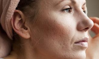 4 cách trị mụn rỗ hiệu quả ai cũng cần biết