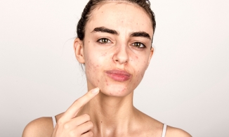 Cách trị mụn quanh miệng hiệu quả, an toàn