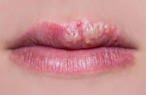Cách trị mụn nước ở môi nhanh chóng, an toàn