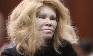 Biến hình thành 'người sư tử' do phẫu thuật thẩm mỹ quá đà