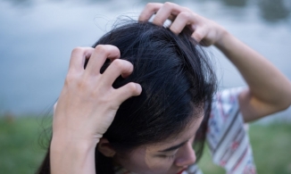 Tuyệt chiêu giúp tóc bớt gàu trong mùa hè