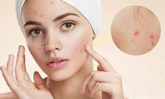 Ưu và nhược điểm của việc sử dụng Hydrogen Peroxide trị mụn