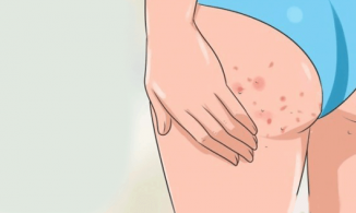 Nguyên nhân và cách phòng ngừa mụn mông hiệu quả