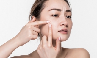 Mụn đầu trắng: Nguyên nhân và các biện pháp phòng ngừa