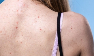 Cách trị mụn lưng tại nhà hiệu quả từ chuyên gia