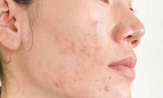 Cách trị mụn viêm hiệu quả: Những điều bạn không thể bỏ qua