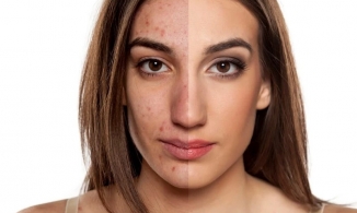 8 lời khuyên về chăm sóc da mụn viêm từ chuyên gia