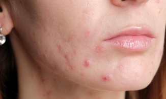 Cách trị mụn bọc tại nhà hiệu quả ai cũng cần biết