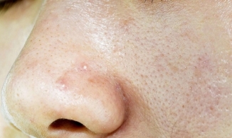 Bật mí cách chăm sóc da dầu mụn lỗ chân lông to hiệu quả nhất