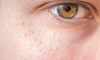 Bật mí cách trị mụn thịt hiệu quả không phải ai cũng biết