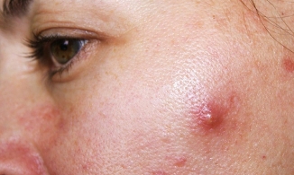 Cách trị mụn nang hiệu quả nhưng đơn giản, dễ thực hiện tại nhà