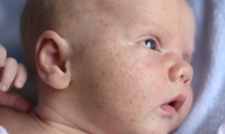 Cách trị mụn sữa ở trẻ sơ sinh các mẹ cần biết