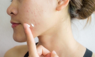 4 cách trị mụn thâm tại nhà hiệu quả giúp làn da sạch mụn, đều màu
