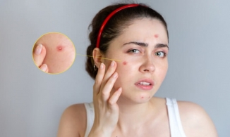 4 cách trị mụn mủ sưng to hiệu quả nhất dành cho bạn