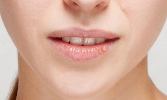 Môi xinh mọc mụn: Đâu là cách trị mụn ở môi nhanh nhất