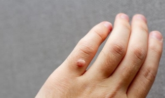 Bật mí cách trị mụn cơm hữu hiệu