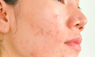 Bỏ túi những cách trị mụn viêm sưng đỏ cực kỳ hiệu quả