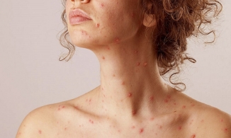Mẹo nhỏ giúp bạn chăm sóc da sau khi bị thủy đậu