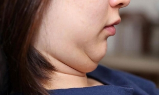 Bạn nên ăn gì để giảm mỡ mặt hiệu quả?