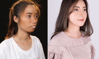 Cô gái Phú Thọ lột xác sau 2 lần phẫu thuật thẩm mỹ khiến mọi người trầm trồ 